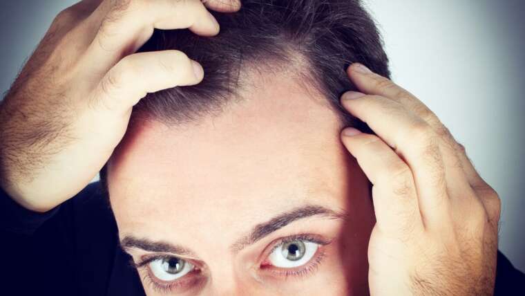 Hair Loss Solutions and Tips for Men