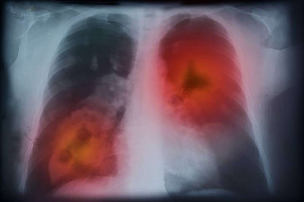 Enhancing Accuracy in Lung Cancer Diagnosis