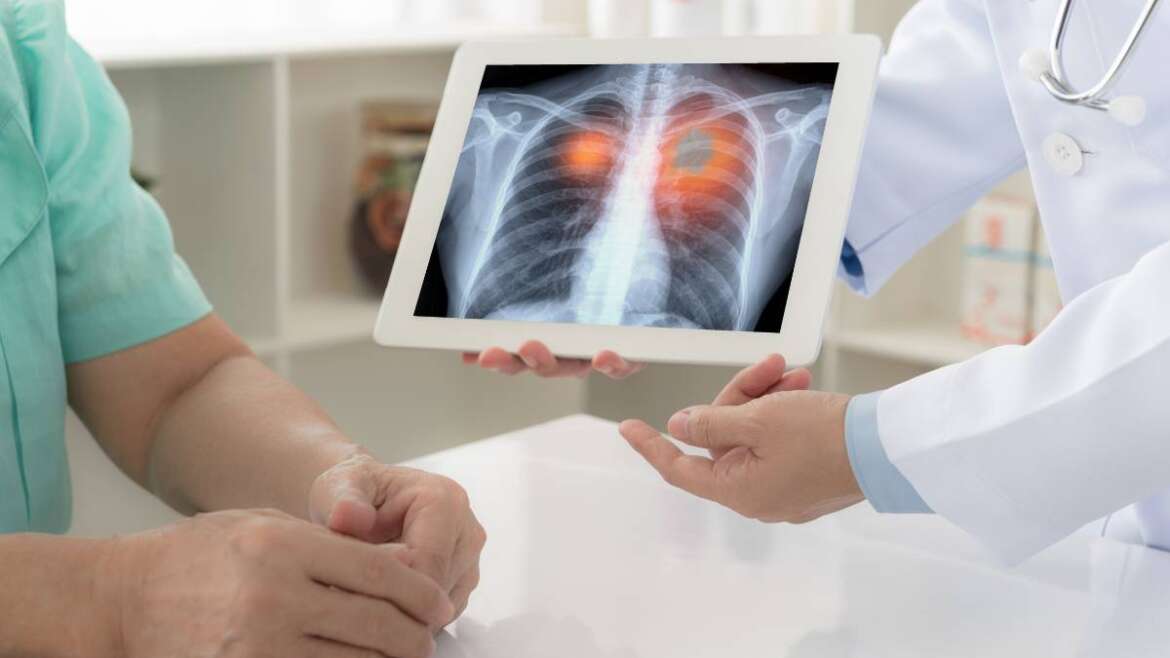 Ways to Prevent and Manage Lung Cancer in Men