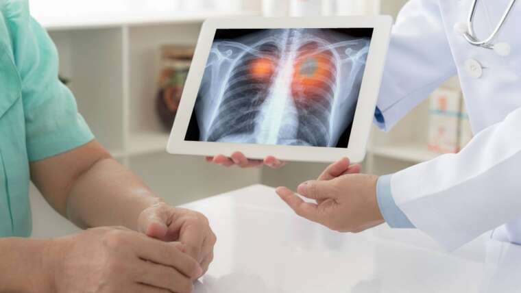 Ways to Prevent and Manage Lung Cancer in Men